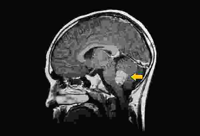 An MRI Scan Of A Child's Brain, Showing A Tumor In The Cerebellum The Changing Faces Of Childhood Cancer: Clinical And Cultural Visions Since 1940 (Science Technology And Medicine In Modern History)