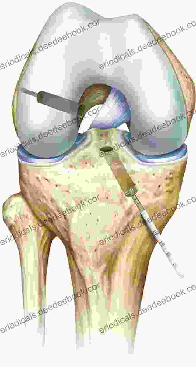 Anterior Cruciate Ligament Reconstruction Surgery Anterior Cruciate Ligament Reconstruction: A Practical Surgical Guide