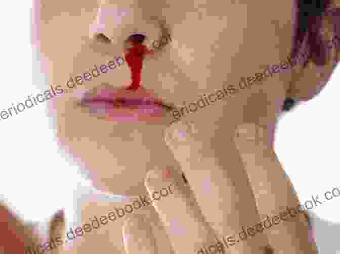 Image Of Epistaxis Showing A Person With A Nosebleed Diagnosis In Otorhinolaryngology: An Illustrated Guide