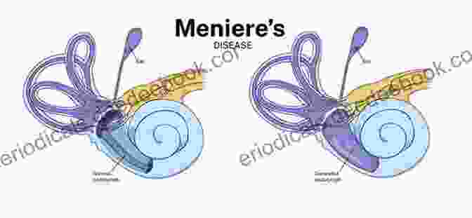 Image Of Meniere's Disease Showing A Person Experiencing Vertigo Diagnosis In Otorhinolaryngology: An Illustrated Guide