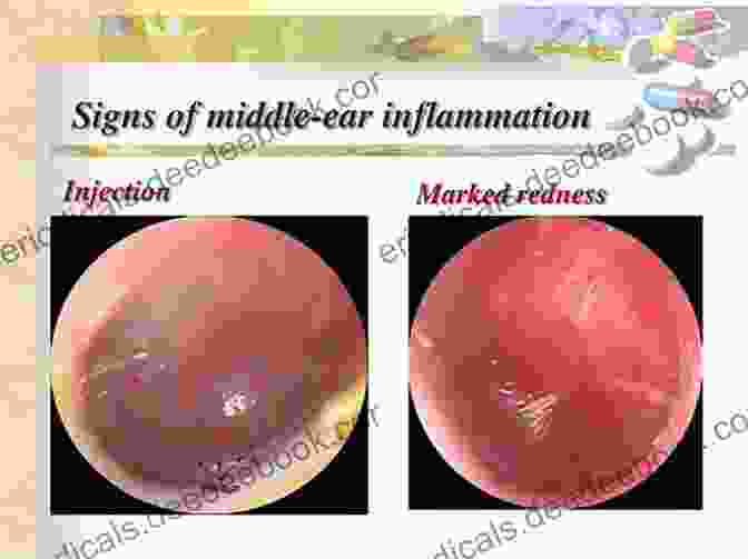 Image Of Otitis Media Showing A Red And Inflamed Eardrum Diagnosis In Otorhinolaryngology: An Illustrated Guide